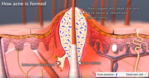 Acnes caused by acne causing microorganisms cross sectional diagram..jpg